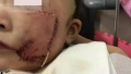 3岁男孩被宠物狗撕坏半张脸 眼睛下部缝30多针